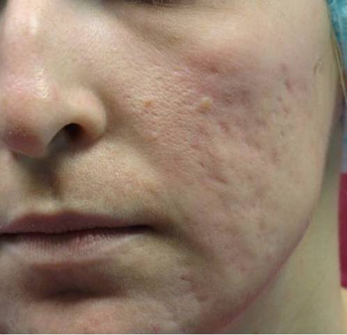 Enerpeel piling TCA - after one month